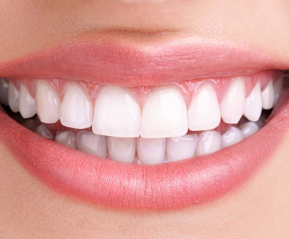Izbeljivanje zuba Dr Svetlana Novaković Dental & Aesthetic Centar Sremska Mitrovica