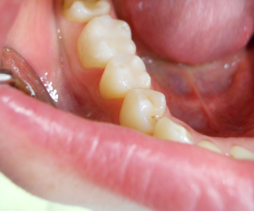 Uklanjanje kamenca Dr Svetlana Novaković Dental & Aesthetic Centar Sremska Mitrovica